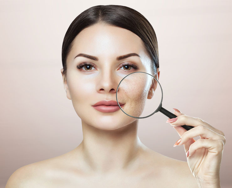 Woman holding magnifying glass to face showing acne scars | ICON - Scarring