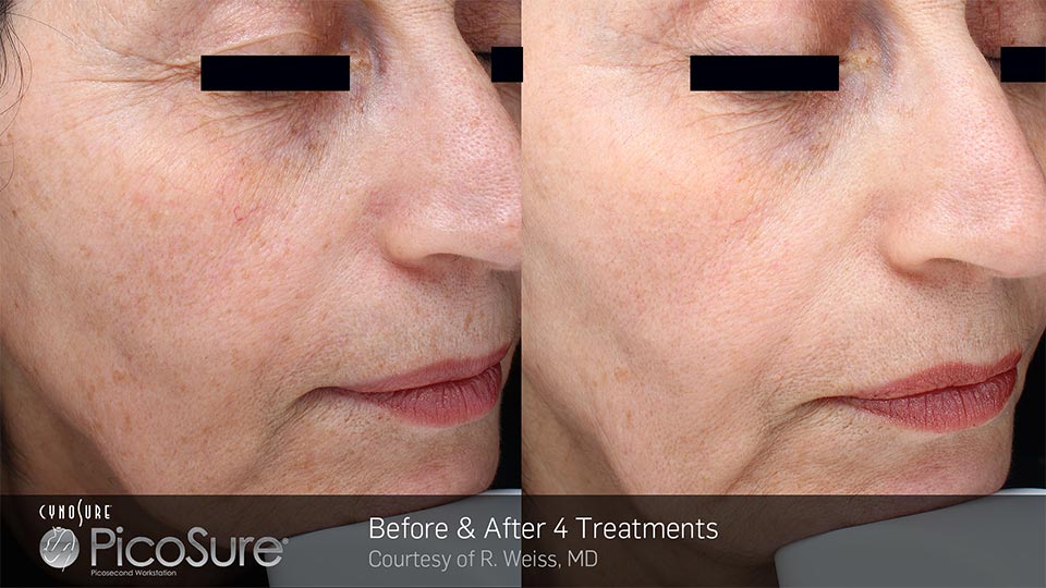 PicoSure Before & After