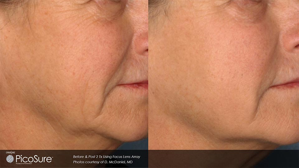 PicoSure Before & After