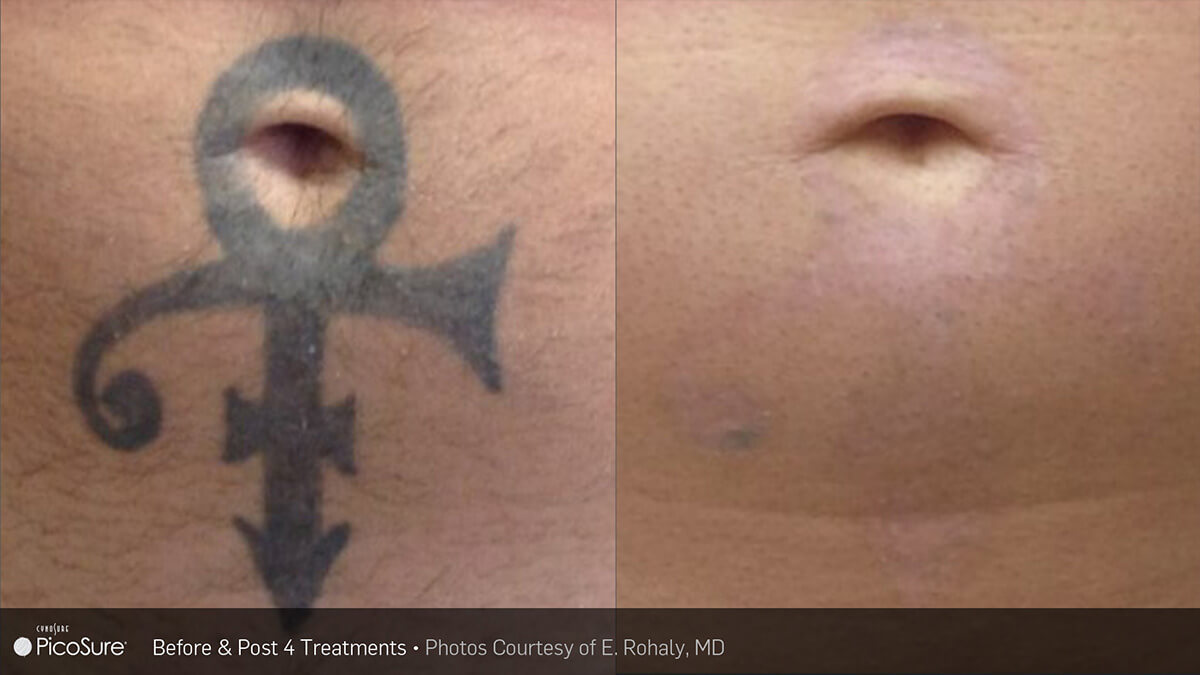 PicoSure Tattoo Removal Before & After