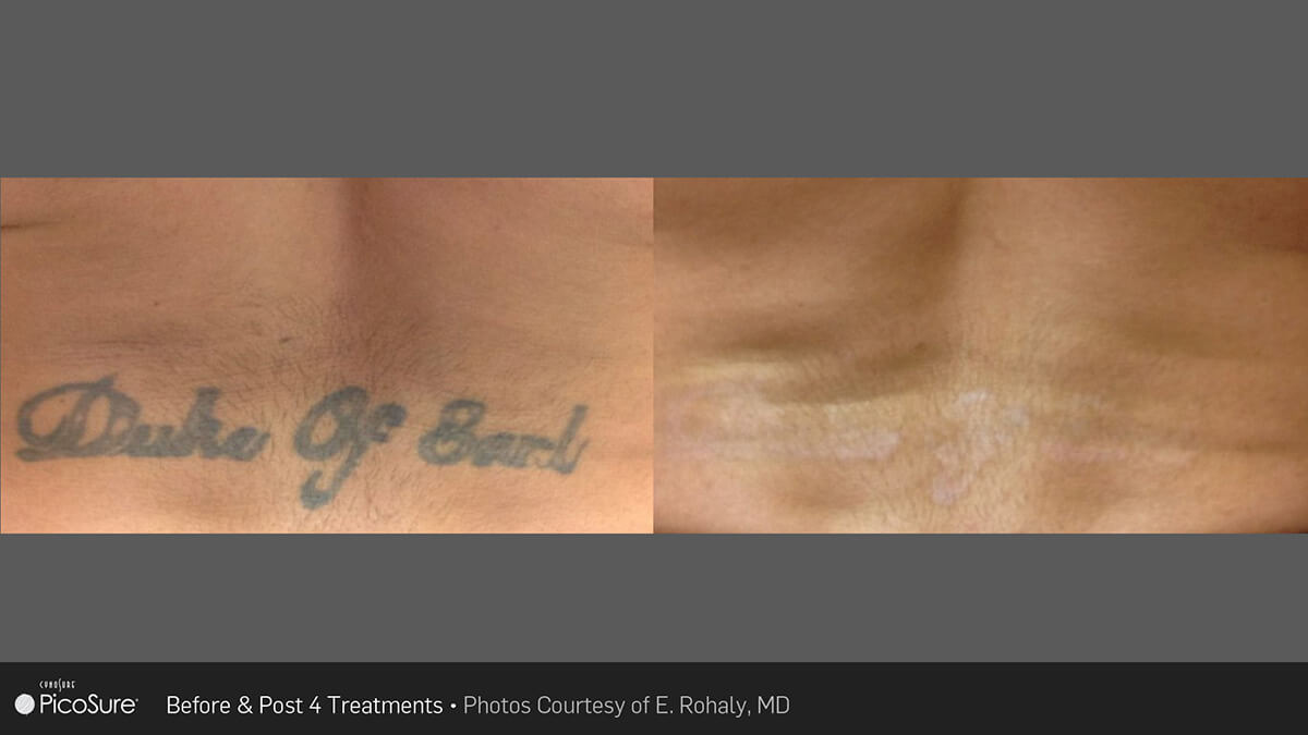 PicoSure Tattoo Removal Before & After